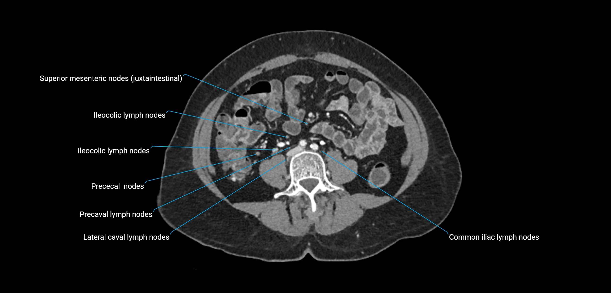 CT ct abdominal lymph nodes  axial cross sectional anatomy  enchanced radiology image -img-00002-00265.webp